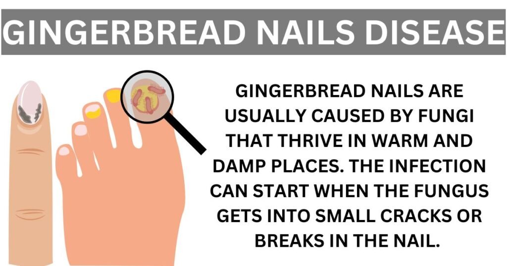 Gingerbread Nails Disease