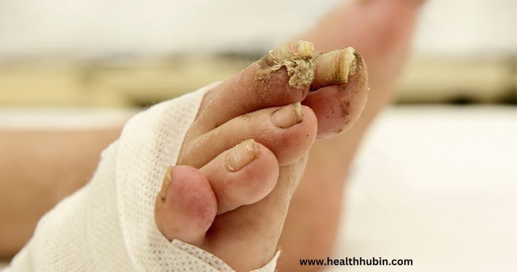 gingerbread nails disease complications