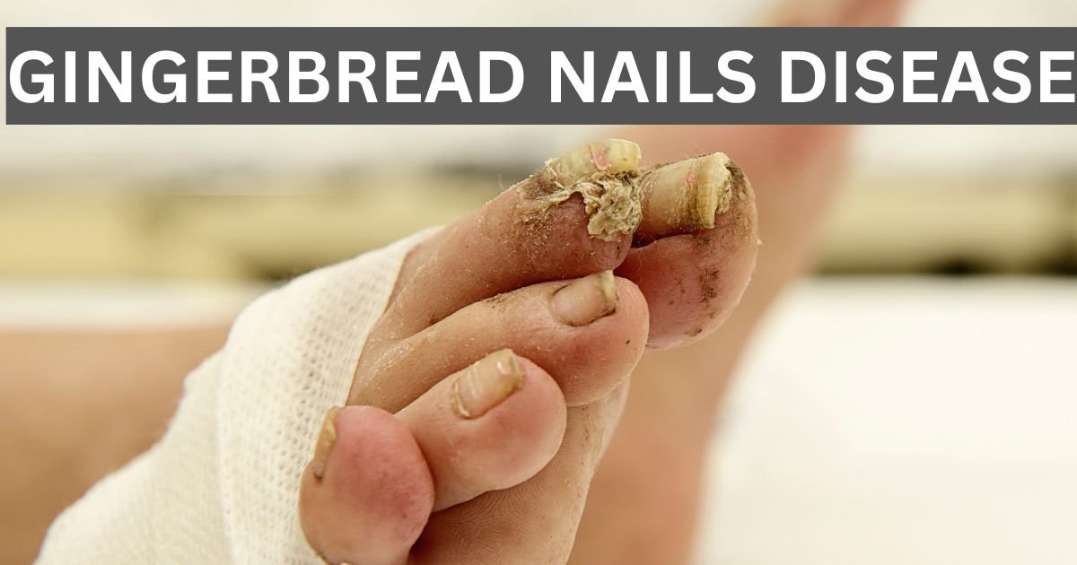 Gingerbread Nails Disease