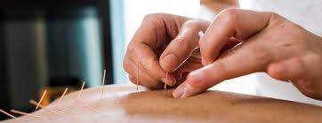 The Healing Power of Acupuncture & Traditional Chinese Medicine in Sydney