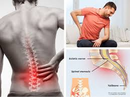 Chiropractic Care for Sciatica Simple Help for Nerve Pain
