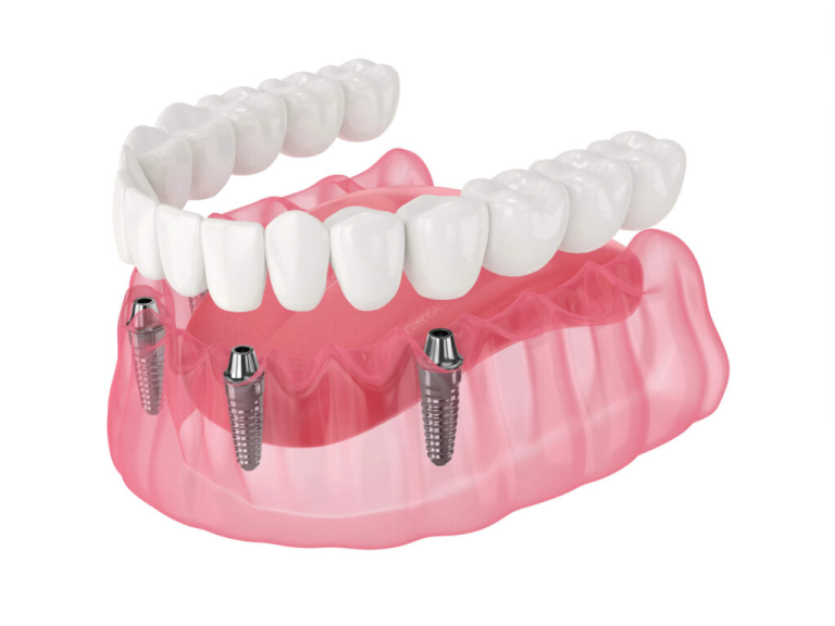All-on-X Dental Implants: Is Full Mouth Restoration Right for You?
