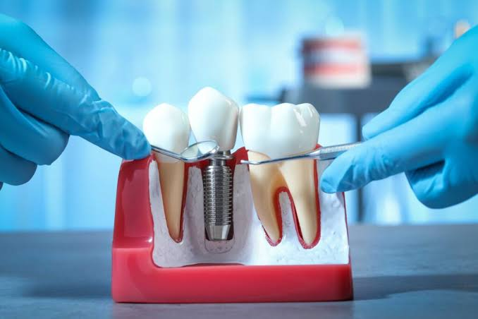 Dental Implant Procedure: Step-by-Step Explained
